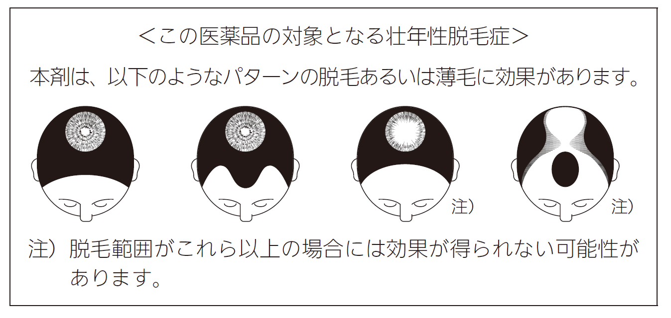 壮年性脱毛症について