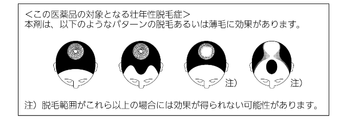 壮年性脱毛症について